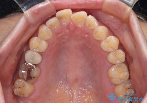 【モニター】飛び出た前歯を整えたい ワイヤー矯正治療の治療前