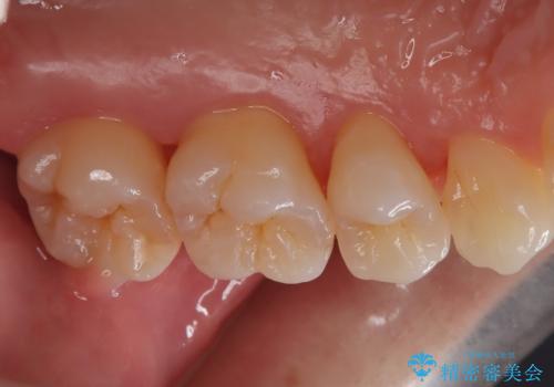 歯周病治療【オープンフラップ】の治療後