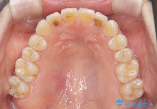 前歯の目立つガタつきをマウスピース矯正で治療の治療後