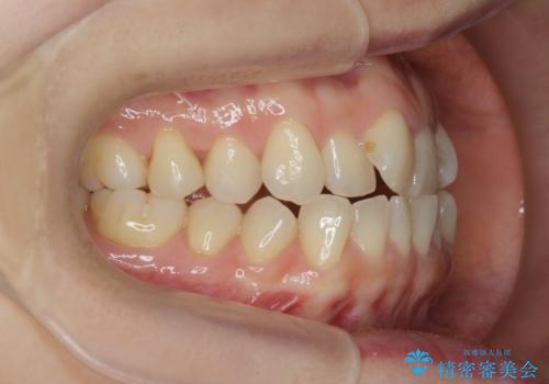 前歯の目立つガタつきをマウスピース矯正で治療の治療前