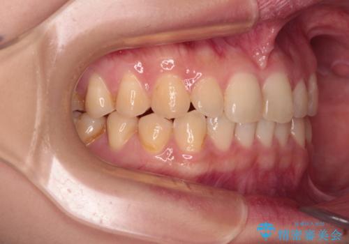 治療途中の奥歯と矯正治療の後戻り インビザライン・ライトによる矯正治療の治療後