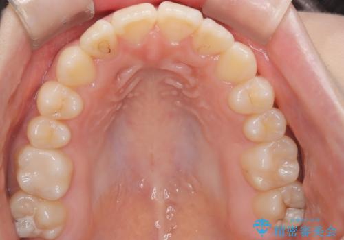 マウスピース矯正で前歯のガタツキを改善!　短期間で治療完了の治療後