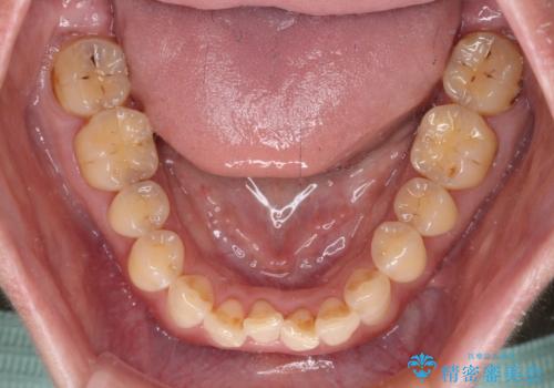 【モニター】飛び出た前歯を整えたい ワイヤー矯正治療の治療前