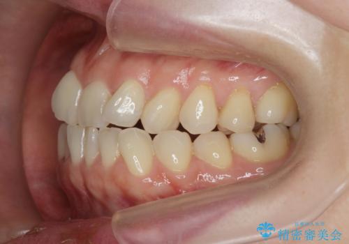 前歯の目立つガタつきをマウスピース矯正で治療の治療前
