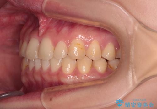 治療途中の奥歯と矯正治療の後戻り インビザライン・ライトによる矯正治療の治療後