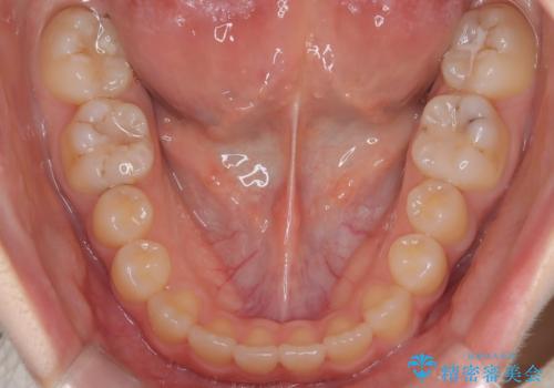 マウスピース矯正で前歯のガタツキを改善! 短期間で治療完了の治療後