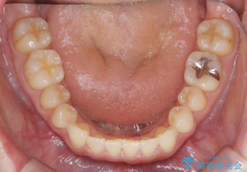 前歯の目立つガタつきをマウスピース矯正で治療の治療後