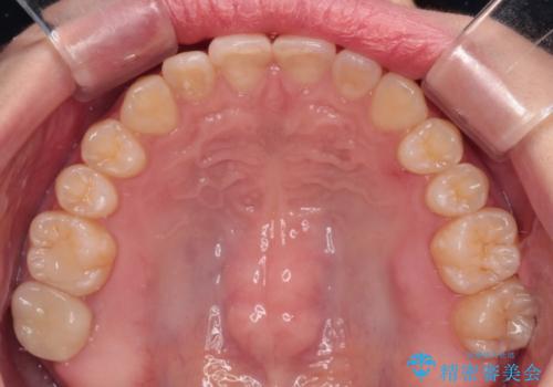 治療途中の奥歯と矯正治療の後戻り インビザライン・ライトによる矯正治療の治療後