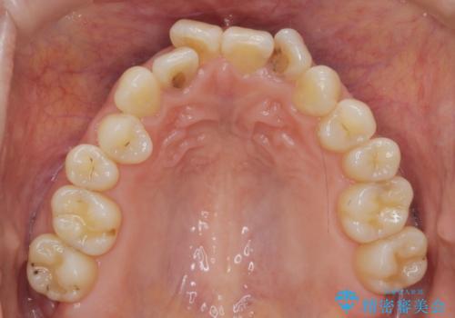 前歯の目立つガタつきをマウスピース矯正で治療の治療前