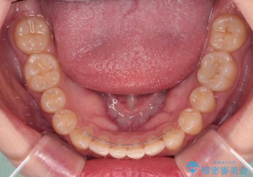 治療途中の奥歯と矯正治療の後戻り インビザライン・ライトによる矯正治療の治療後