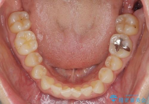 前歯の目立つガタつきをマウスピース矯正で治療の治療前