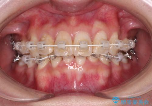 デコボコと深い咬み合わせ　ワイヤー装置での抜歯矯正の治療中