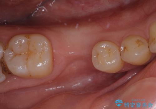 空いている時間を利用して通院 奥歯のインプラント治療の症例 治療前