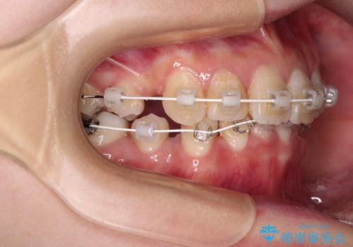 デコボコと深い咬み合わせ ワイヤー装置での抜歯矯正の治療中