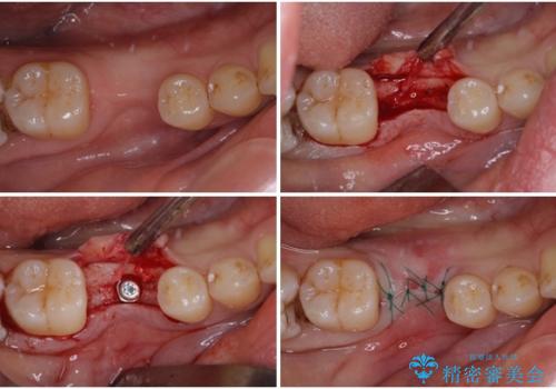 空いている時間を利用して通院 奥歯のインプラント治療の治療中
