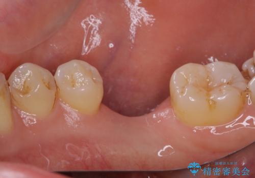 空いている時間を利用して通院 奥歯のインプラント治療の治療前