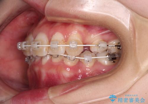 デコボコと深い咬み合わせ ワイヤー装置での抜歯矯正の治療中