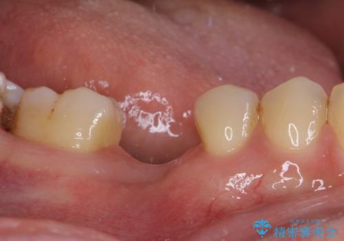 空いている時間を利用して通院 奥歯のインプラント治療の治療前