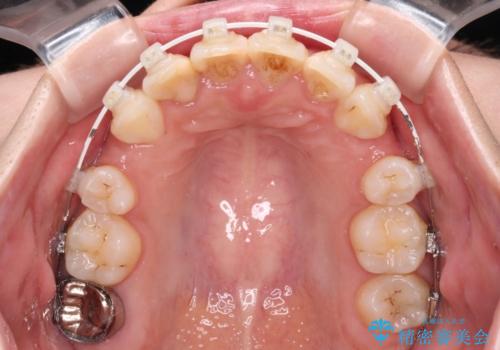 デコボコと深い咬み合わせ ワイヤー装置での抜歯矯正の治療中