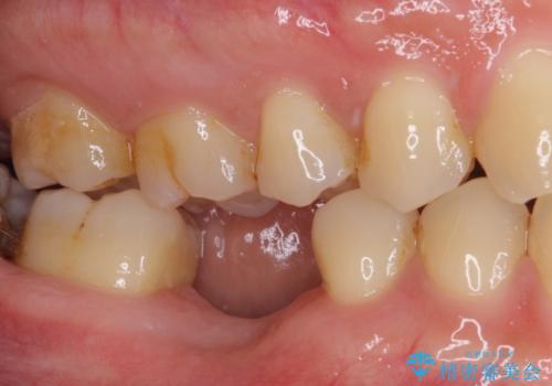空いている時間を利用して通院 奥歯のインプラント治療の治療前