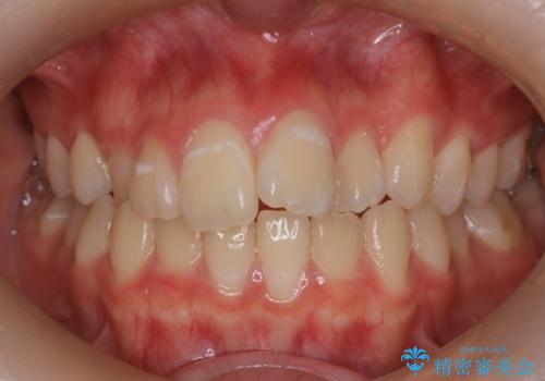 マウスピース矯正で前歯のガタツキを改善!　短期間で治療完了の症例 治療前