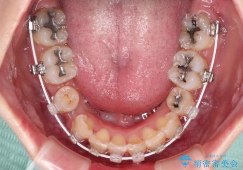 デコボコと深い咬み合わせ　ワイヤー装置での抜歯矯正の治療中