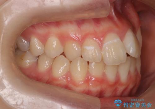 マウスピース矯正で前歯のガタツキを改善! 短期間で治療完了の治療前