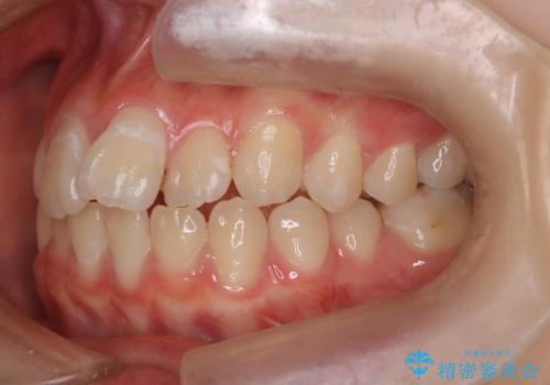 マウスピース矯正で前歯のガタツキを改善! 短期間で治療完了の治療前