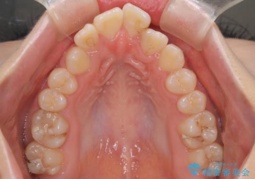 マウスピース矯正で前歯のガタツキを改善! 短期間で治療完了の治療前