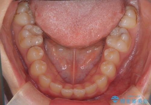 マウスピース矯正で前歯のガタツキを改善!　短期間で治療完了の治療前