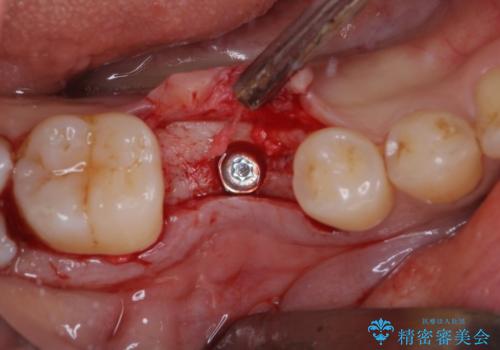 空いている時間を利用して通院 奥歯のインプラント治療の治療中