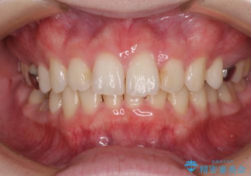 インビザラインによる矯正治療と奥歯のインプラント治療の治療中