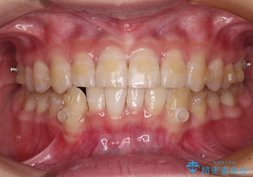 【モニター】下顎前歯のデコボコをインビザラインできれいにの治療中