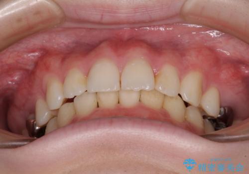 インビザラインによる矯正治療と奥歯のインプラント治療の治療中
