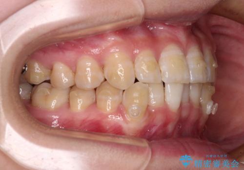 【モニター】下顎前歯のデコボコをインビザラインできれいにの治療中