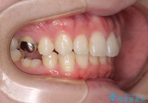 インビザラインによる矯正治療と奥歯のインプラント治療の治療中