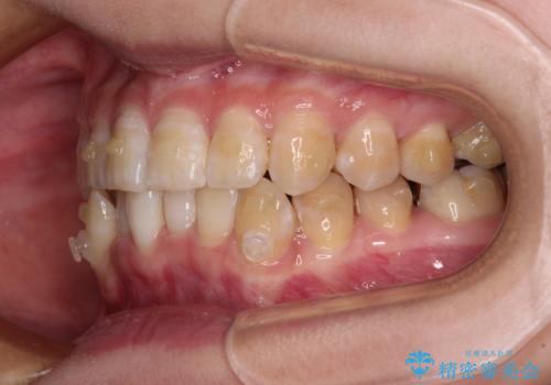 【モニター】下顎前歯のデコボコをインビザラインできれいにの治療中