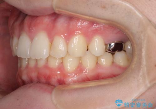 インビザラインによる矯正治療と奥歯のインプラント治療の治療中