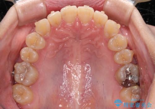 【モニター】下顎前歯のデコボコをインビザラインできれいにの治療中