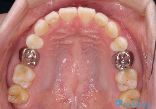 インビザラインによる矯正治療と奥歯のインプラント治療の治療中