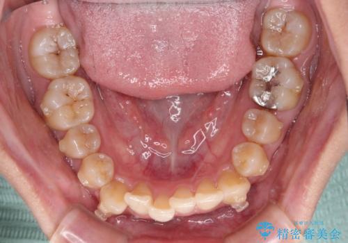 【モニター】下顎前歯のデコボコをインビザラインできれいにの治療中