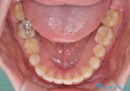 インビザラインによる矯正治療と奥歯のインプラント治療の治療中