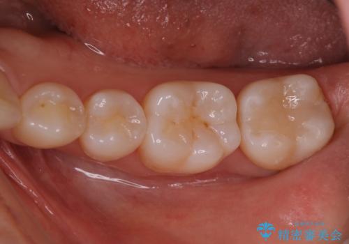 銀歯を白いセラミックに変えたい　セラミックインレーの治療後