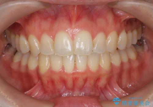 前歯のガタつきをマウスピースで治したい!の症例 治療後