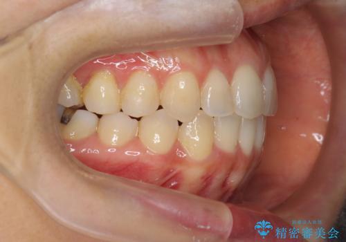 前歯のガタつきをマウスピースで治したい!の治療後