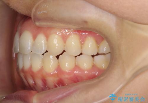 前歯のガタつきをマウスピースで治したい!の治療後