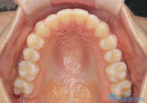 前歯のガタつきをマウスピースで治したい!の治療後