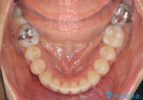 前歯のガタつきをマウスピースで治したい!の治療後