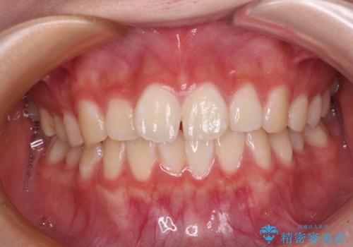 インビザラインは使える自信がない ワイヤー装置にて矯正治療の症例 治療前