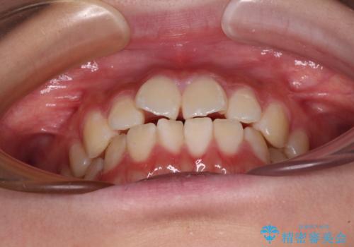 インビザラインは使える自信がない ワイヤー装置にて矯正治療の治療前